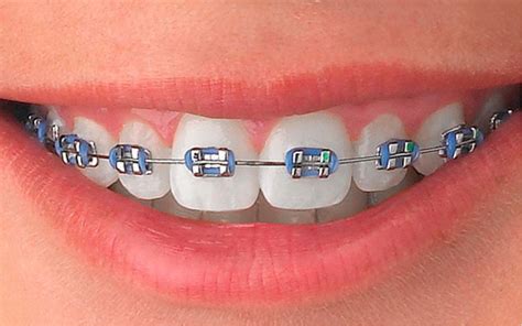 precio de brackets metalicos en peru|precio de brackets peru.